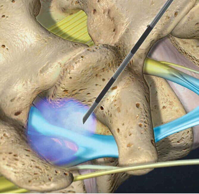 Можно ставить блокаду. Эпидуральная блокада при грыже. Блокада грыжи поясничного отдела позвоночника. Фораминальная блокада Корешков. Сакральная эпидуральная блокада.