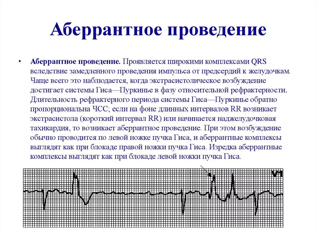 Аберрантная наджелудочковая экстрасистолия на ЭКГ. Наджелудочковые экстрасистолы с аберрантным проведением на ЭКГ. Аберрантные желудочковые комплексы на ЭКГ. Суправентрикулярная экстрасистолия с аберрантным проведением. Аберрантные экстрасистолы