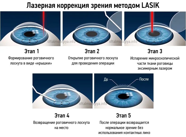 Сколько раз делают коррекцию зрения