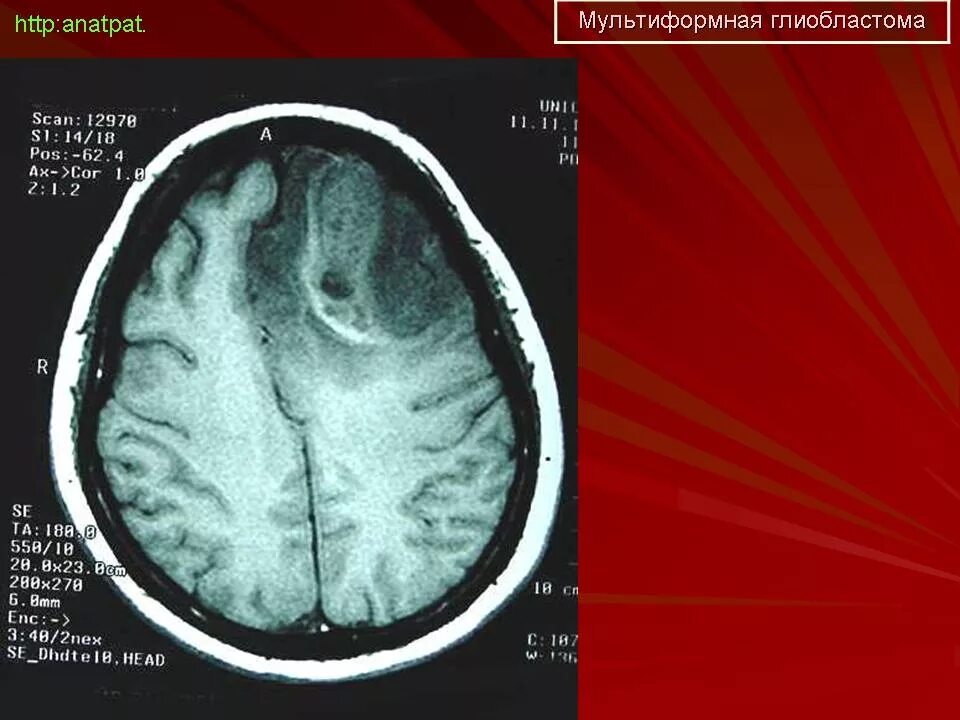 Мультиформной глиобластомы. Глиобластома головного мозга. Мультиформная глиобластома на мосту.