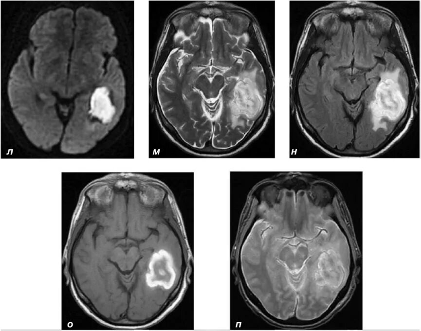 Ишемия мозга мрт. Геморрагический инсульт гематома мрт. Мрт ишемический инсульт т1. Внутримозговая гематома на т2.