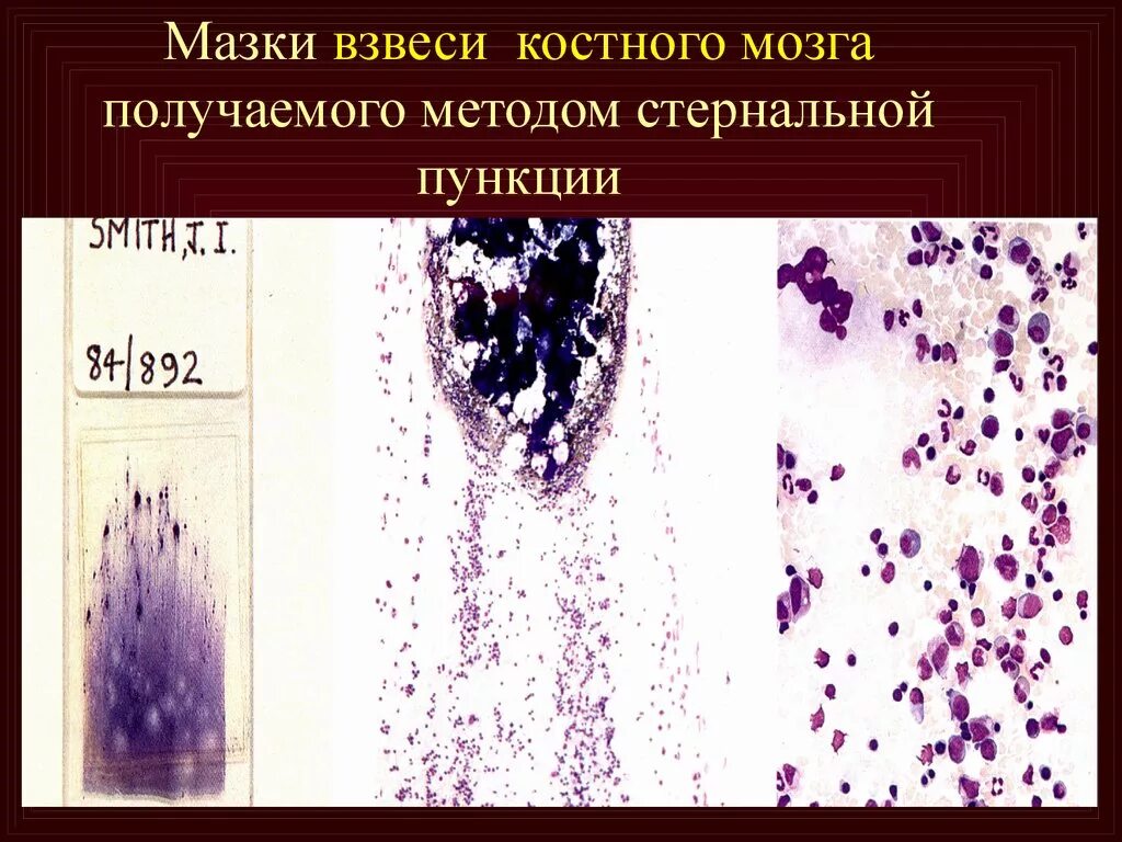 Мазок костного мозга. Красный костный мозг азур 2 эозин. Гистологический препарат мазок красного костного мозга. Мазок красного костного мозга гематоксилин эозин. Мазок костного мозга.