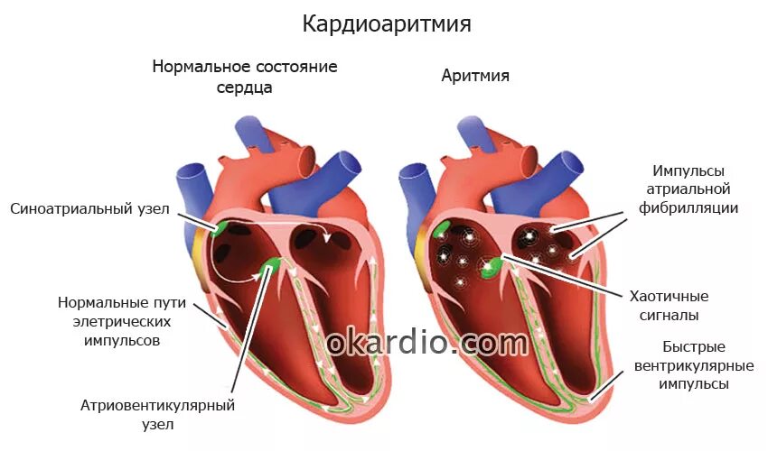 Аритмия сердца. Нарушение сердечного ритма. Аритмия симптомы. Заболевания сердца аритмия. Как понять что говорит сердце