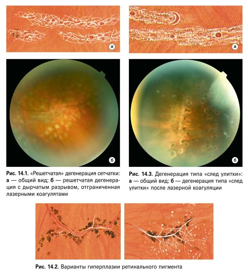 Периферические ретинальные дегенерации. Витреохориоретинальная дистрофия сетчатки. Перипапиллярная дистрофия сетчатки. Булыжная Мостовая дегенерация сетчатки. Периферическая дистрофия сетчатки след улитки.