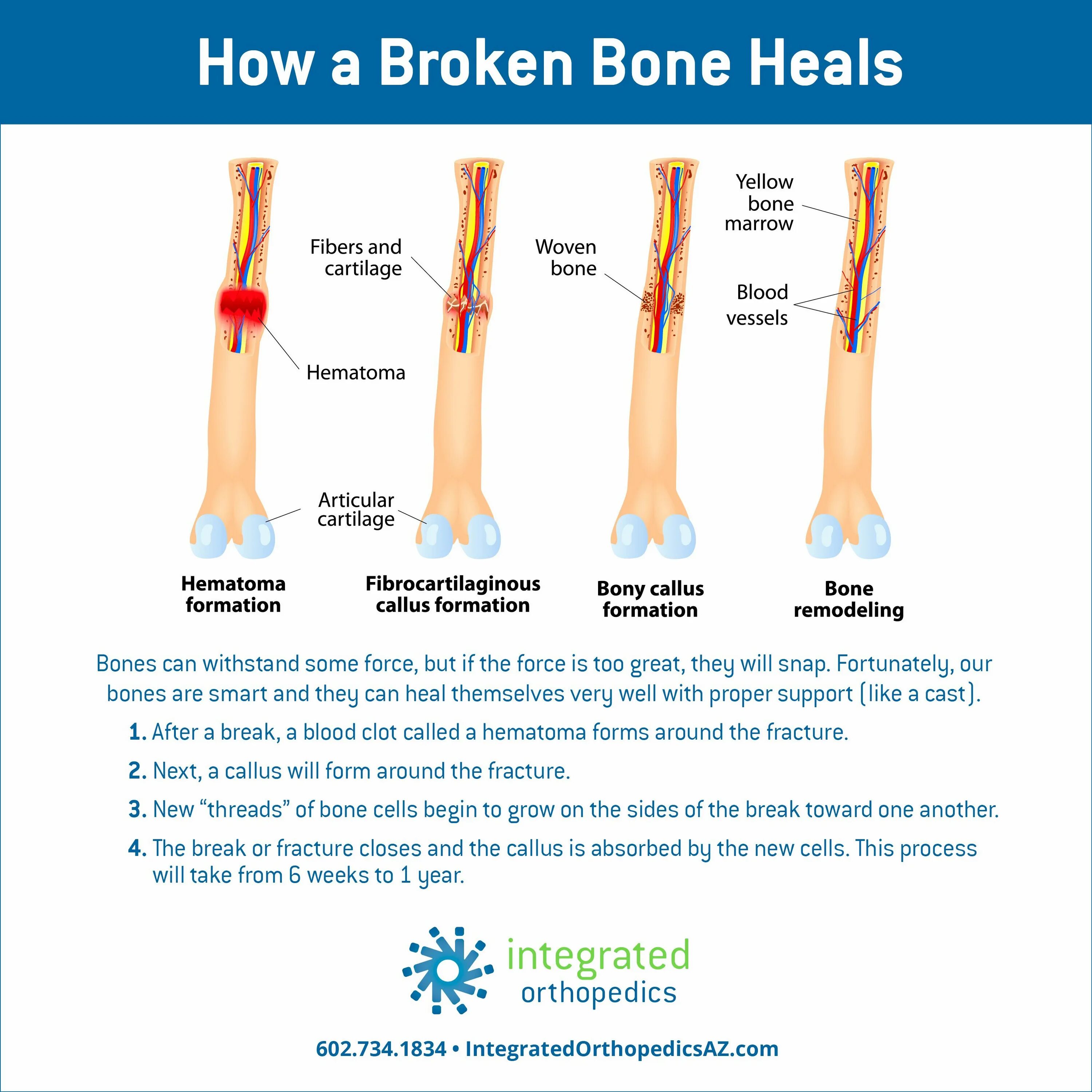 The fracture can be. The fracture can be