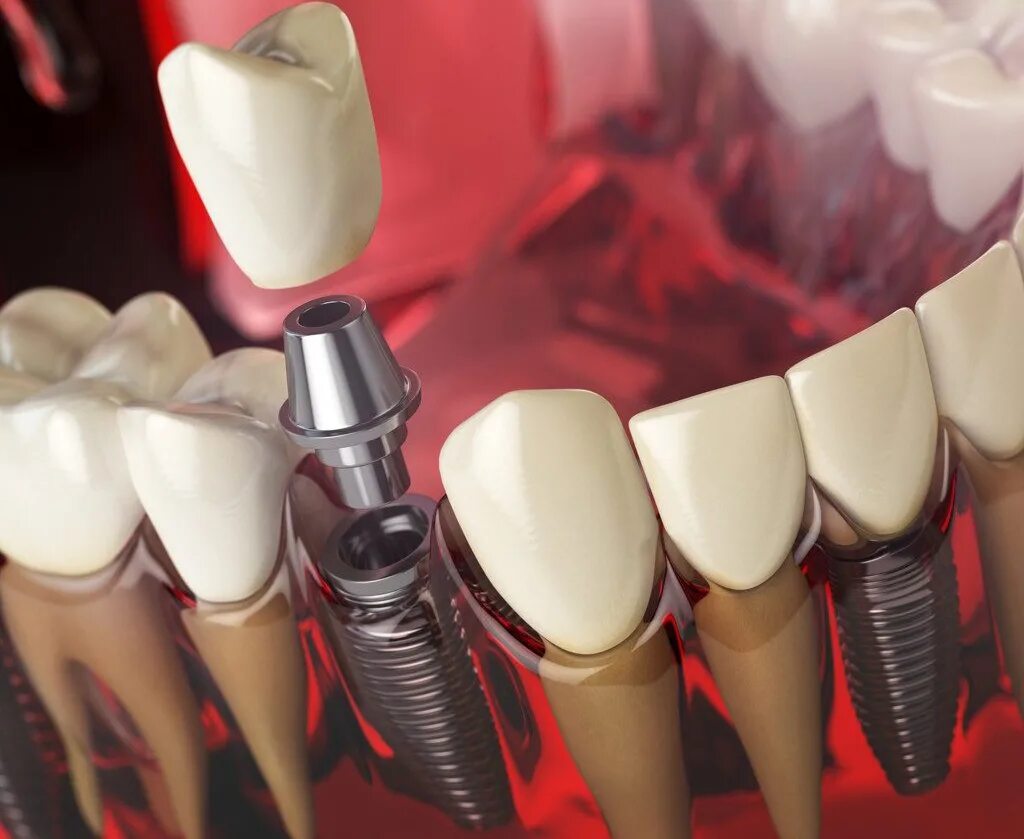 Имплантат blx штрауман. Имплант dentium superline. Абатмент анкилоз. Без имплантантов. Без имплантантов.
