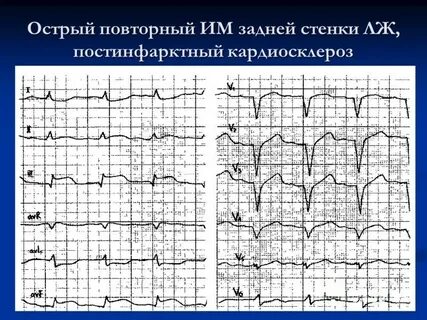 Постинфарктное экг