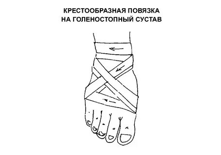 Какая повязка накладывается при растяжении голеностопных связок