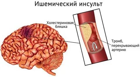 Инсульт артериальный