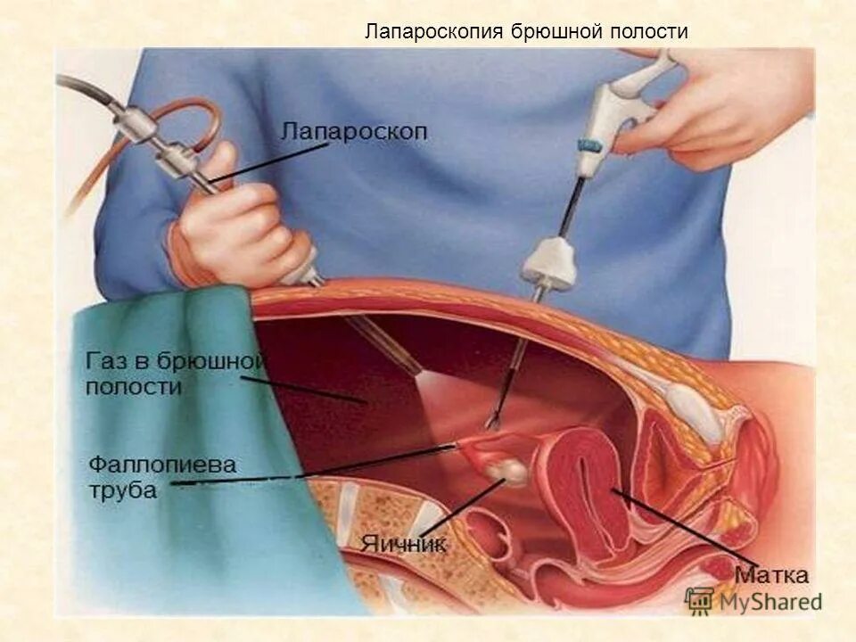 Удаление матки по омс