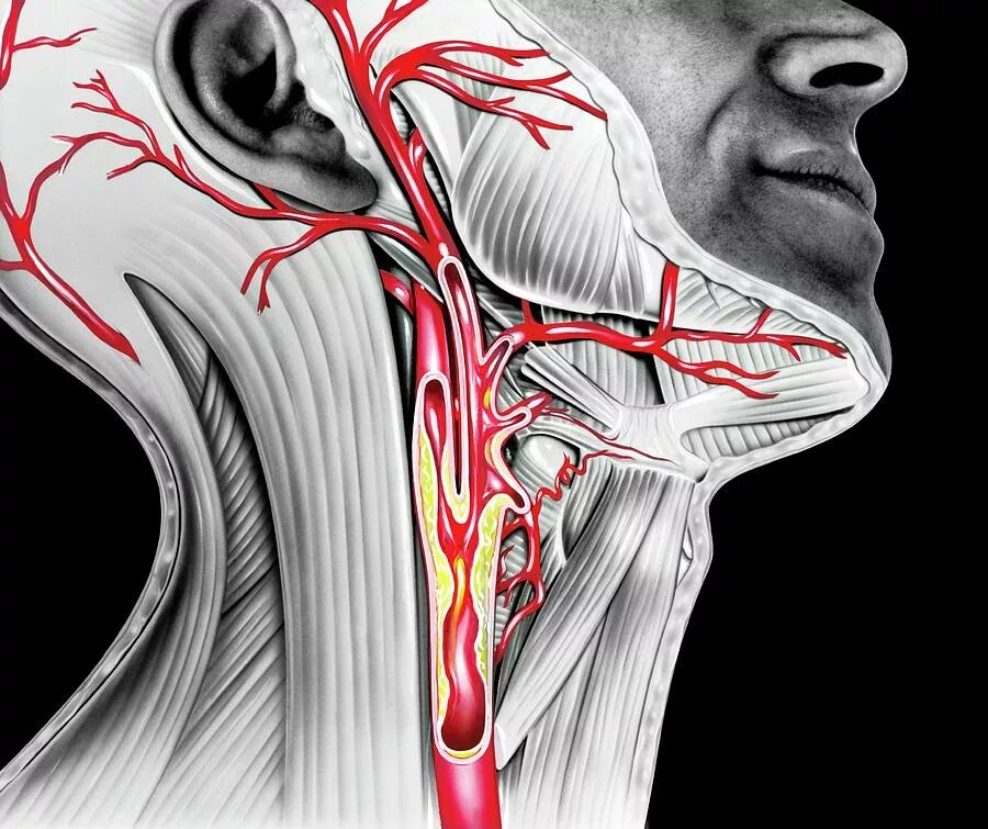 Каротидная бифуркация. Анатомия сонных артерий шеи. Каротидная бифуркация сонной артерии.