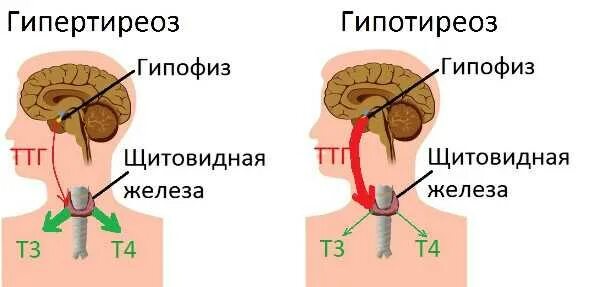 Гипотиреоз и гипертиреоз щитовидной железы. Гипертиреоз щитовидной железы симптомы. Сравнительная таблица гипо и гипертиреоз. Гипотиреоз и гипертиреоз щитовидной железы. Щитовидка гипотиреоз и гипертиреоз.