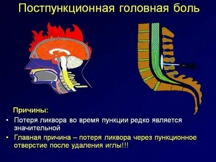 Головные боли после анестезии