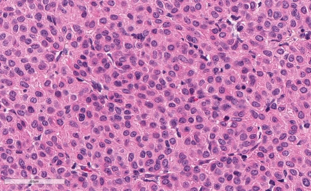 Клетки рида березовского штернберга. Клетка рид березовского штернберга при лимфогранулематозе. Многоядерные клетки березовского-рид-штернберга. Клетки рида березовского штернберга. Клетки рида.