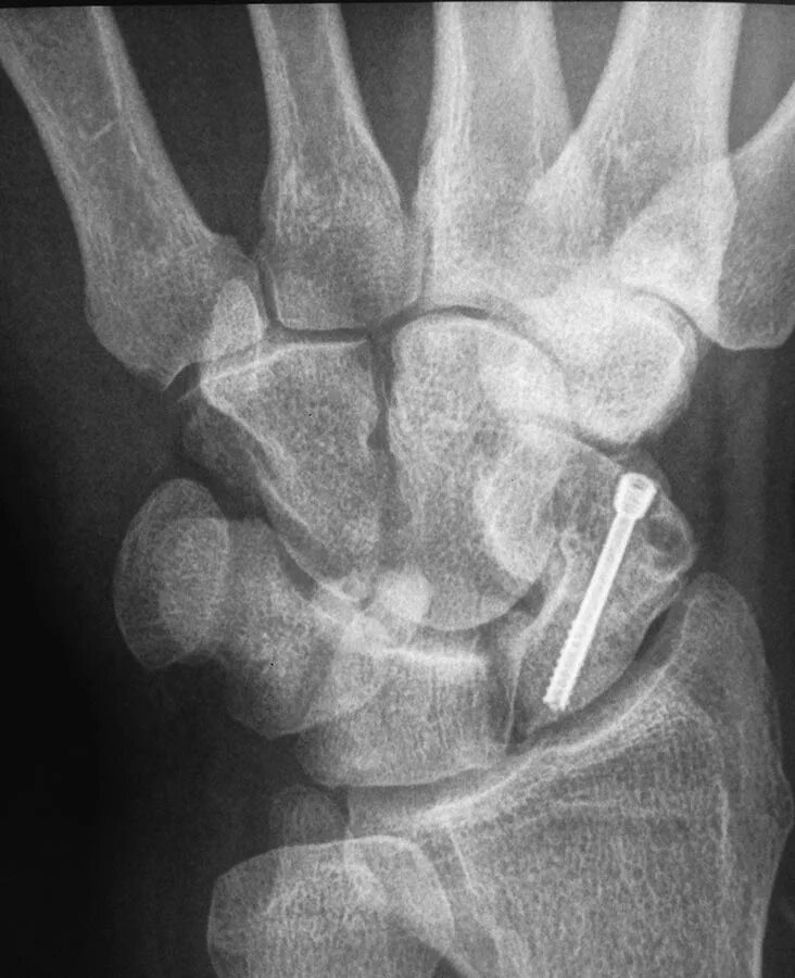 перелом крючковидной кости кисти. перелом трехгранной кости запястья. перелом шиловидного отростка лучевой кости рентген. перелом шиловидного отростка рентген. перелом крючковидной кости запястья рентген.