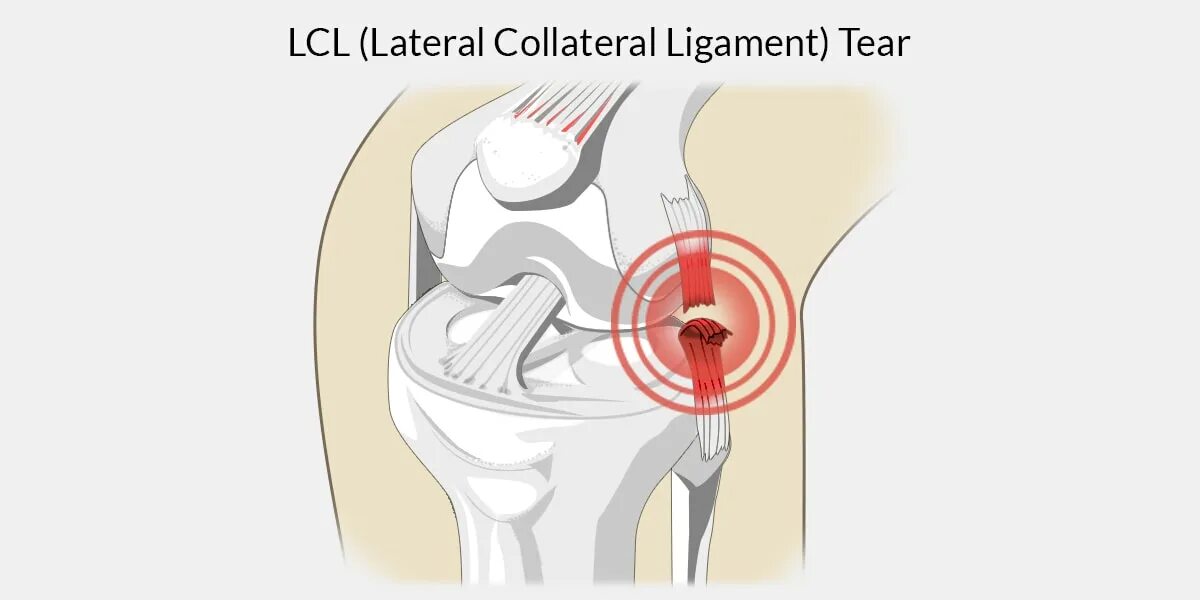 Боль коленной связки. Повреждение латеральной связки коленного сустава. Перерастяжение связок коленного сустава. Разрыв боковой связки колена. Надрыв боковой связки колена.