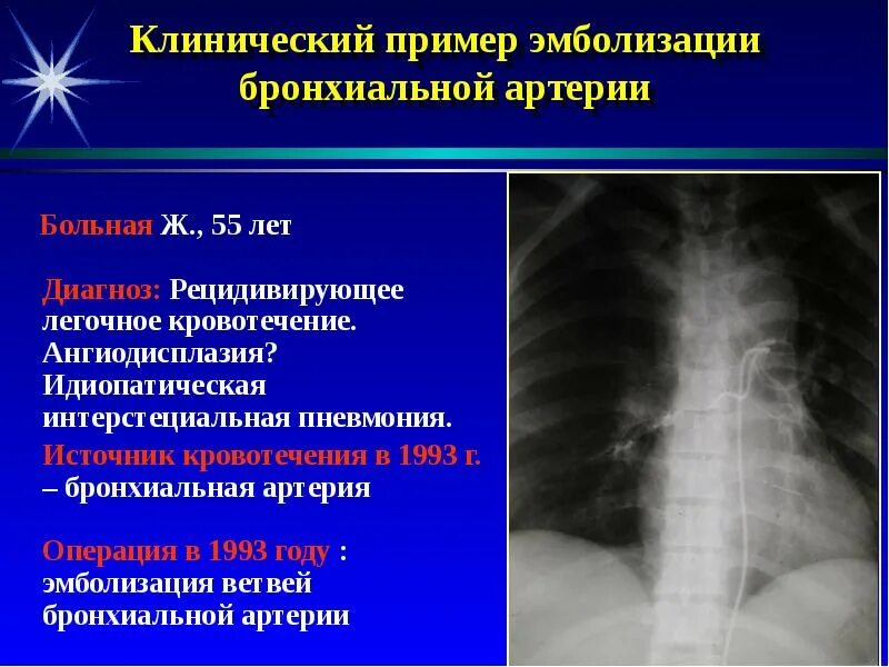 В 19 лет диагноз. Эмболизация бронхиальных артерий. Эмболизация легочных сосудов. Эндоваскулярная эмболизация бронхиальных артерий. Эндоваскулярная эмболизация легочной артерии.