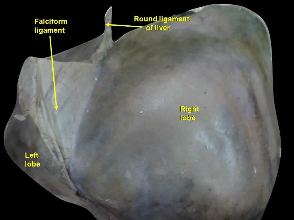 Круглая связка печени – Ligamentum Teres hepatis. Блокада круглой связки печени. Где находятся круглые связки