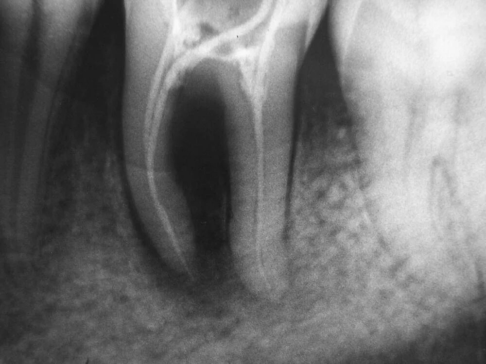 пустоты зуба. пустоты зуба. хронический фиброзный периодонтит схема. острый апикальный периодонтит рентгенограмма. конкрементозный периодонтит.
