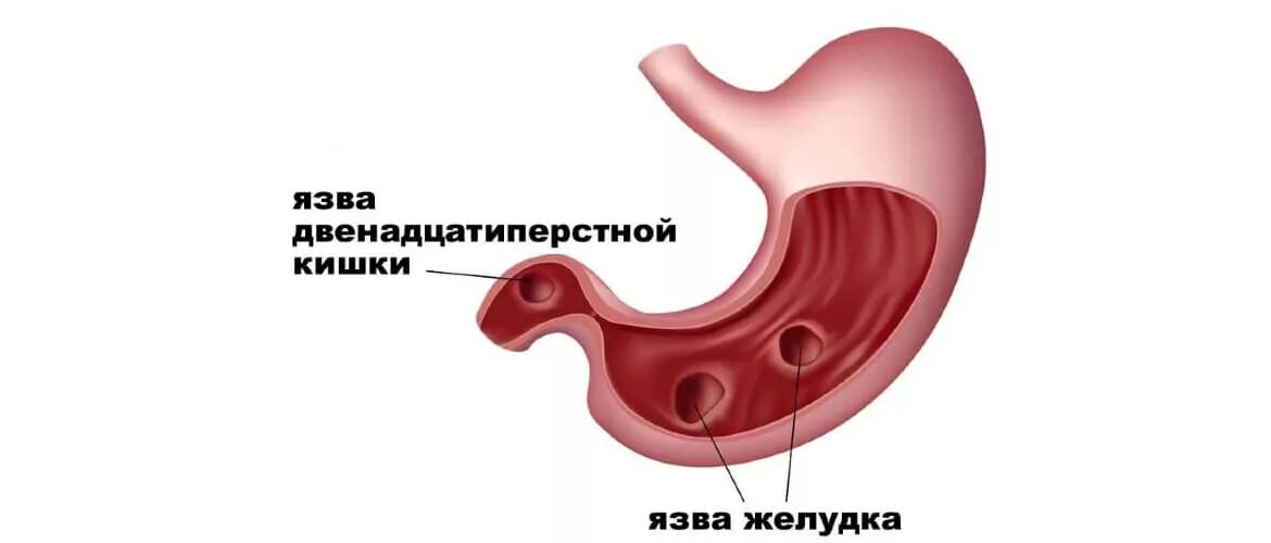 Язв 30. Язвенная болезнь желудка и двенадцатиперстной кишки. Язвенная болезнь желудка и 12 перстной кишки.