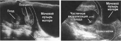Беременность в рубце на матке