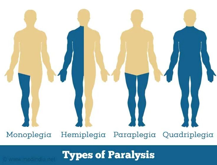 Моноплегия гемиплегия. Спастический паралич моноплегия. Моноплегия и монопарез. Моноплегия параплегия гемиплегия тетраплегия. Гемипарез руки