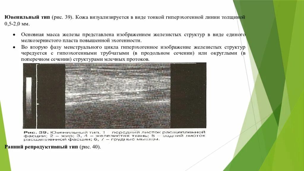 Тип молочной железы в что это. Ювенильный тип молочных желез на узи. ювенильный тип строения молочной железы на узи. морфотип по узи молочных желез. типы строения молочной железы по узи.