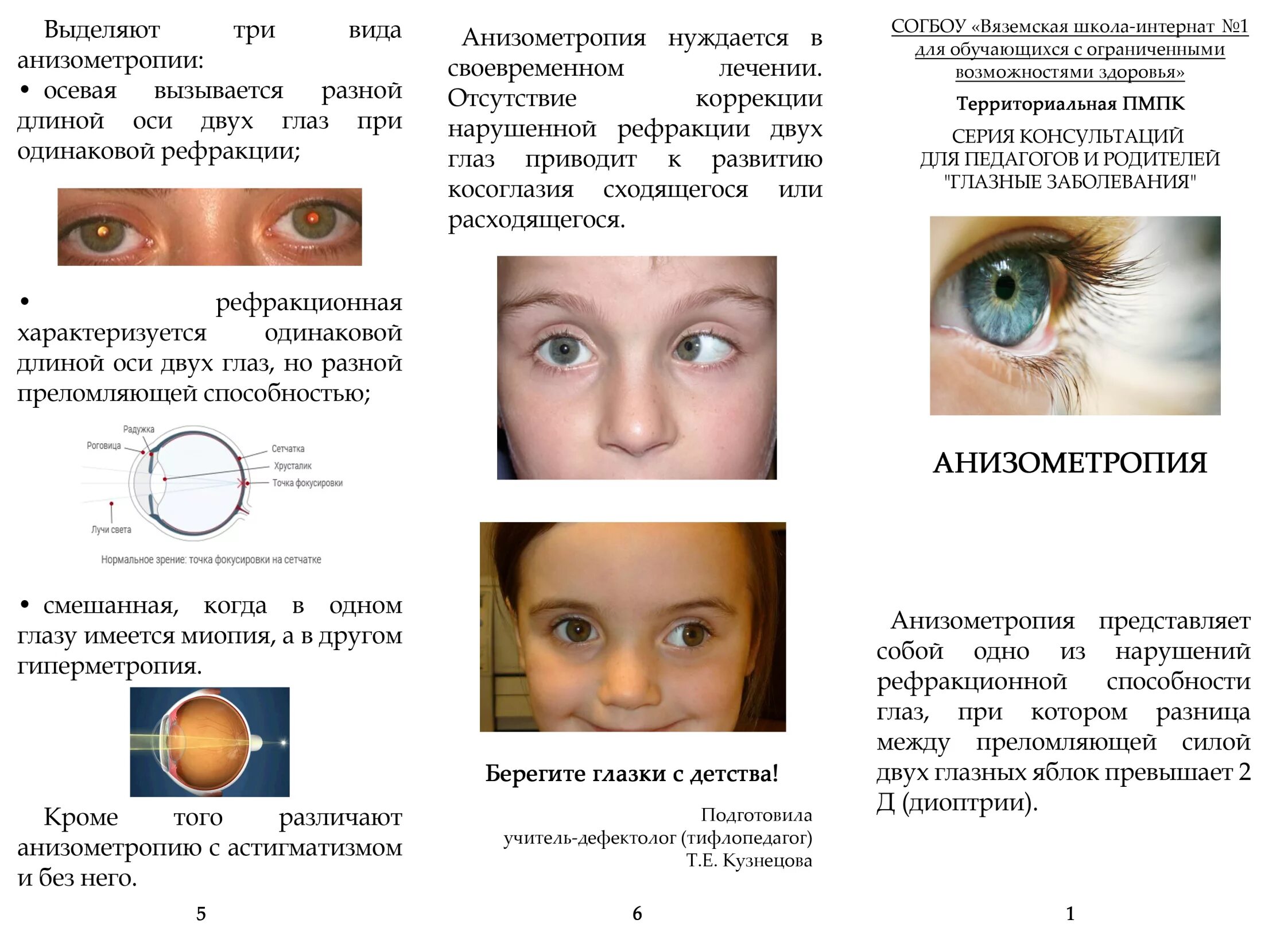 10 лет зрение 2. Нарушения рефракции глаза астигматизм. Астигматизм сложный гиперметропический обоих глаз у ребенка 3 года. Сложный гиперметропический астигматизм у детей в 1 год. Астигматизм нарушение рефракции глаза при котором.