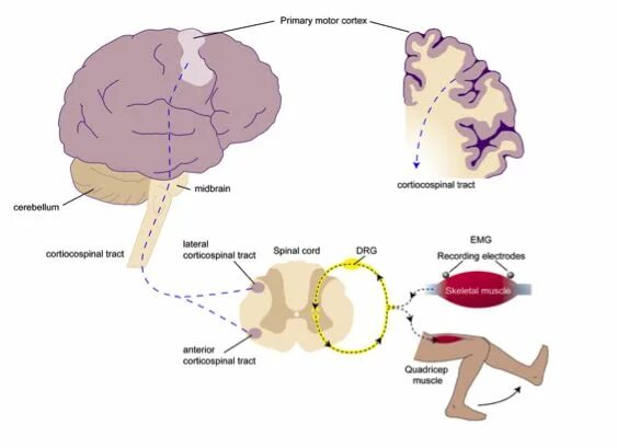 Дцп мозг. Детский церебральный паралич патогенез. Схема мозга и параличей. Церебральный механизм это. Этиология ДЦП схема.