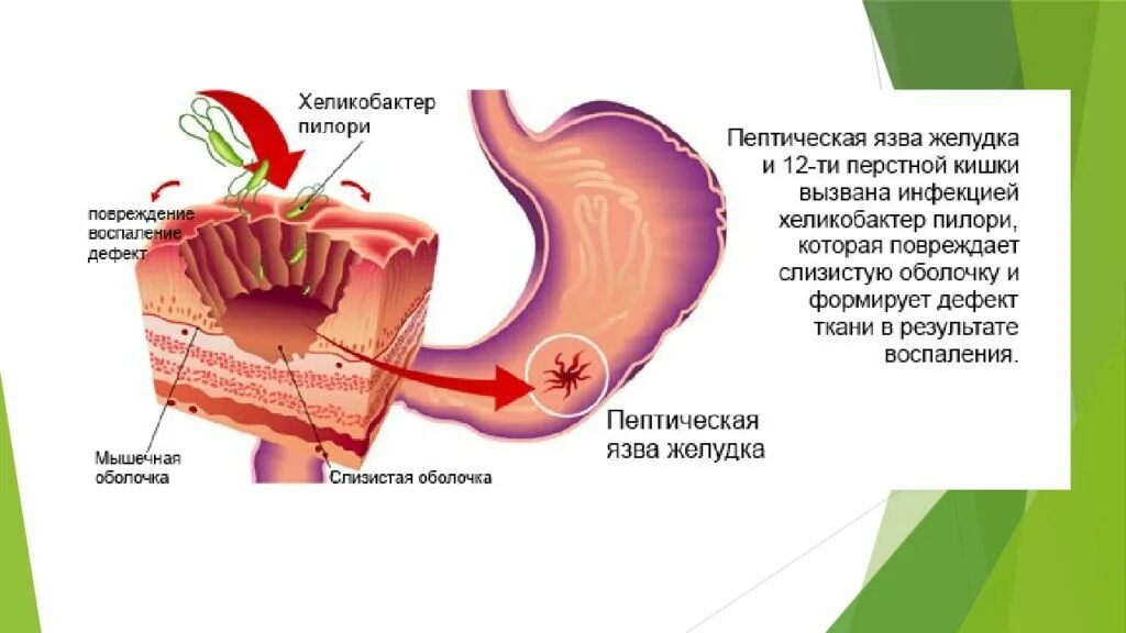 Язва желудка и 12 перстной кишки. Язвенная болезнь желудка язвенная болезнь 12 перстной кишки. Язвенная болезнь 12 перстной кишки кишки. Язва желудка и 12 перстной кишки причины. Осложнения желудка 12 перстной кишки