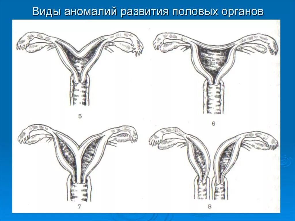 Недоразвитая матка у мужчин. Патологии женских половых органов. Аномалии половых органов. Патология развития женских половых органов. Аномалии женских половых органов.