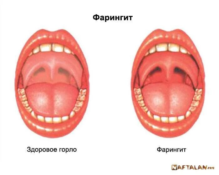 Ротовая полость норма. Стрептококковый тонзиллит зев. Герпетическая ангина зев. Тонзиллиты фарингиты ларингиты.