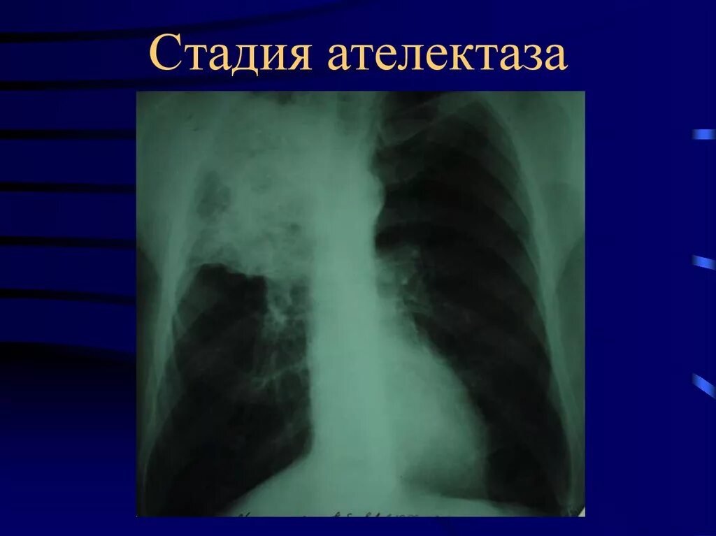 Обтурационный ателектаз легкого рентген. Ателектаз легкого рентгенограмма. Компрессионный ателектаз легкого. Ателектаз легких рентген. Ателектаз нижнего легкого