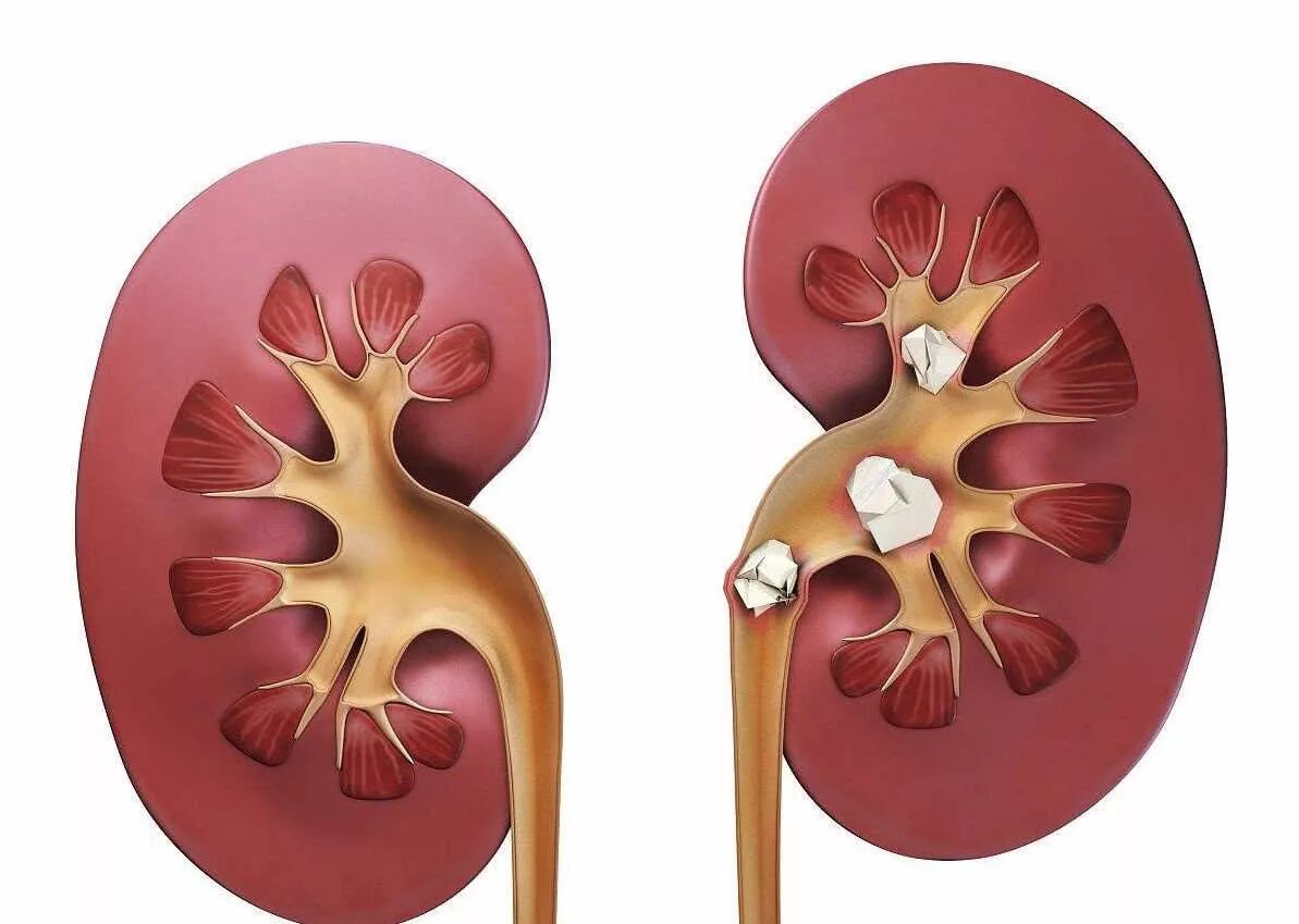 Почечный больной. Коралловидный нефролитиаз. Мочекаменная Почечнокаменная болезнь. ЧЛС почек что это такое.