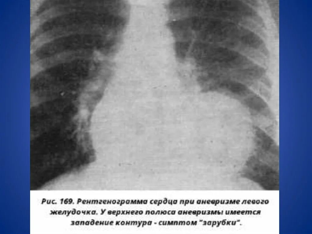 Дилатация правых отделов. Аневризма левого желудочка рентген. Аневризма аорты сердца на рентгене. Расширение правых отделов сердца на рентгенограмме. Рентгенограмма при аневризме аорты.