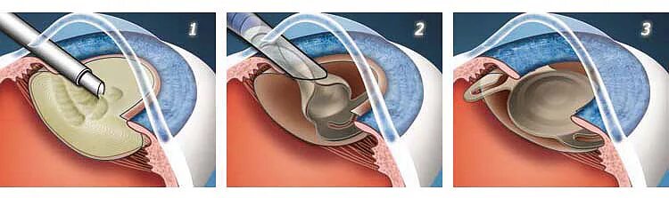 Операция ультразвуковая факоэмульсификация катаракты. Факоэмульсификация катаракты этапы операции. Факоэмульсификация катаракты с имплантацией. Факоэмульсификация катаракты с имплантацией интраокулярной линзы. Замена хрусталика что нельзя делать после операции
