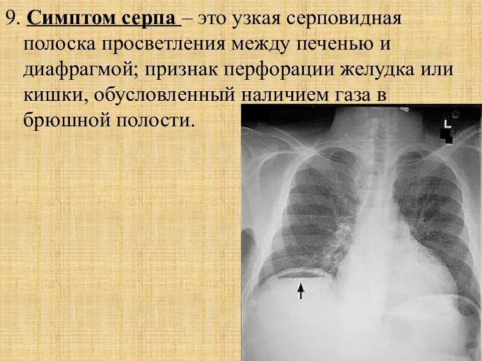 Признаки воздуха в легких. Свободный ГАЗ В брюшной полости рентген. ГАЗ под диафрагмой рентген. Перфорация язвы желудка рентген. Перфоративная язва желудка рентген.