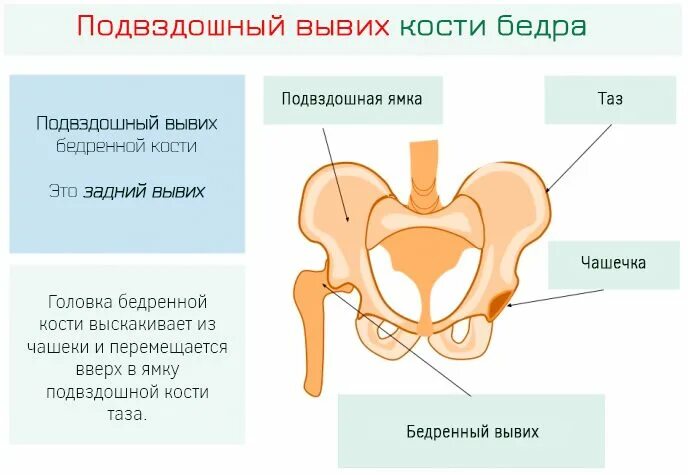 Вывих тазобедренного у взрослых. Механизм вывиха тазобедренного сустава. связка головки бедренной кости растяжение. вывих головки бедренной кости классификация. вывих головки кости бедра.