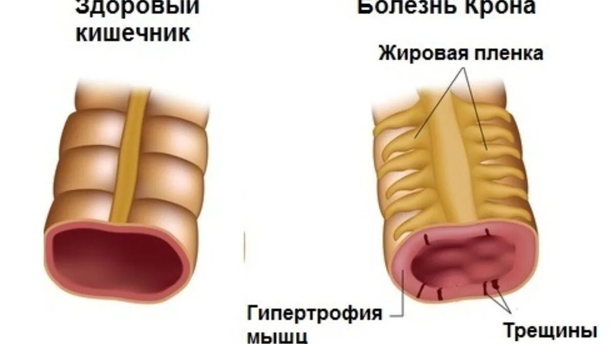 Трещина в кишечнике. Болезнь крона проявления. Болезнь крона кишечник. Болезнь крона тонкой кишки.