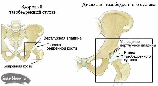 Впадина тазобедренного сустава. Впадина тазобедренного сустава