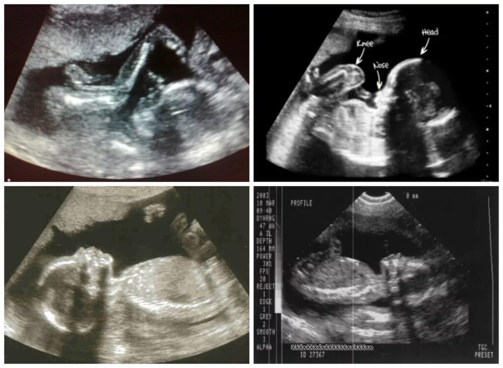 узи 20 недель беременности ошибается ли