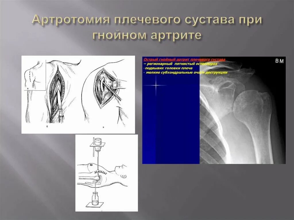 Артротомия плечевого сустава. Артротомия плечевого, локтевого, коленного суставов. Топография плечевого сустава артротомия плечевого сустава. Артротомия плечевого сустава по Лангенбеку. Передне задняя артротомия коленного сустава.