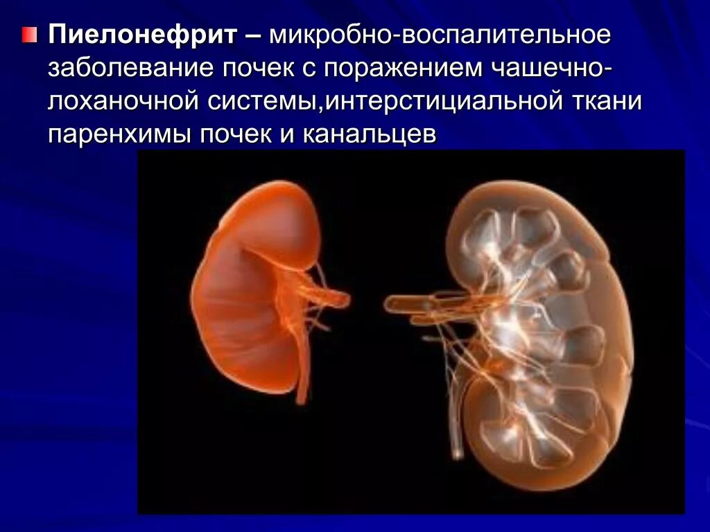 Заболевание почек 6. Пиелонефрит выделительная система. Поражение почечной паренхимы. Болезнь с почками полинефрит.