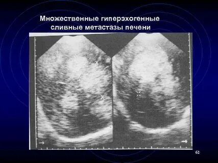 Узи печени гиперэхогенная