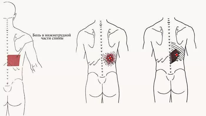 Точки на пояснице. Триггерные точки на спине. Болезненные точки на спине. Карта триггерных точек спины.