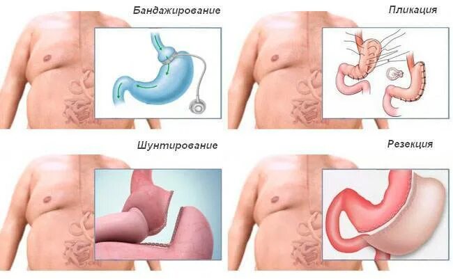 Сколько стоит операция резекция желудка