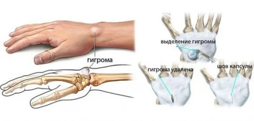 Гигрома запястного сустава. Гигрома лучезапястного сустава кисти. Гигрома лучезапястного сустава операция. Развело кисть руки