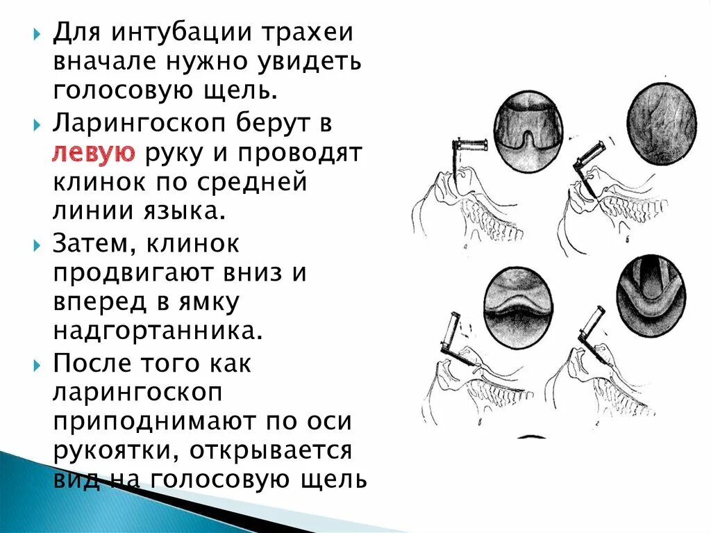 Превентивная интубация трахеи при ботулизме. Голосовая щель при интубации трахеи. проведение интубации трахеи. интубация трахеи схема. техника интубации трахеи.