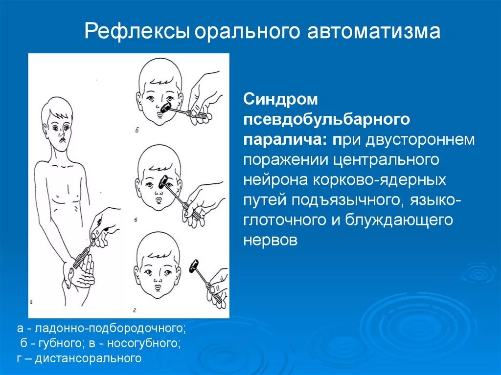 Методика исследования рефлексов орального АВТОМАТИЗМА. Рефлекс орального АВТОМАТИЗМА хоботковый. Псевдобульбарный синдром рефлексы. Симптомы орального АВТОМАТИЗМА.