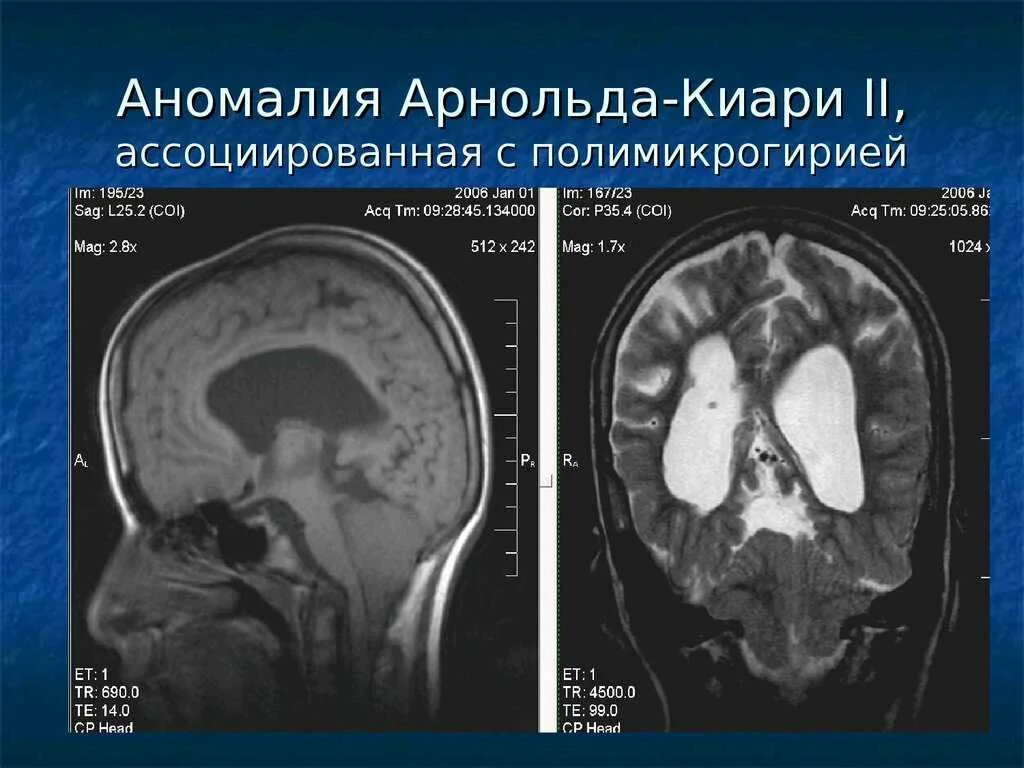 Аномалия мозга Арнольда Киари. Аномалия Арнольда Киари 1 типа мрт головного мозга.